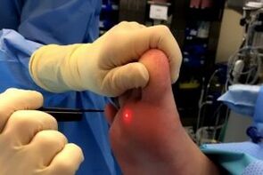 Métodos quirúrgicos para eliminar las verrugas
