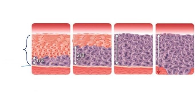 displasia cervical