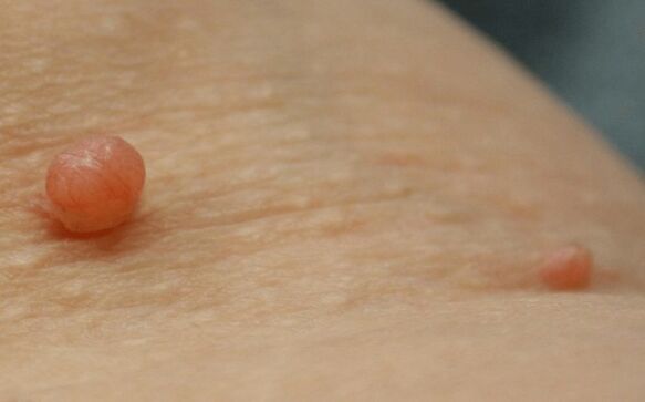 papiloma en el cuerpo