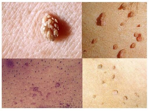 verrugas genitales en el cuerpo
