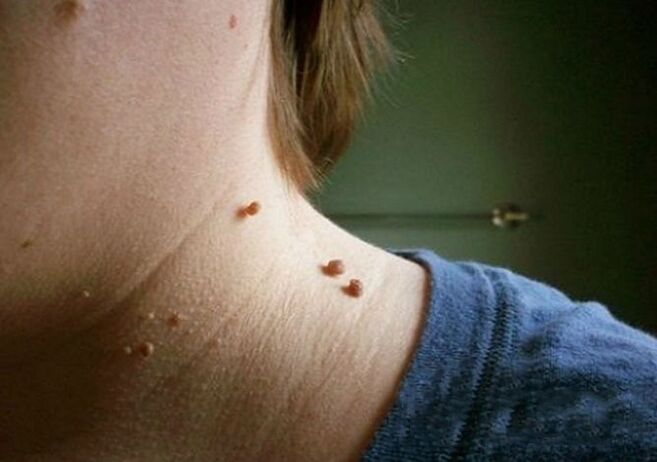 papilomas en el cuello
