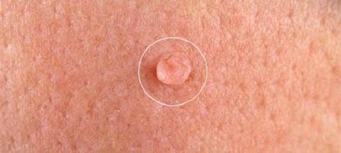 verrugas genitales en el cuerpo