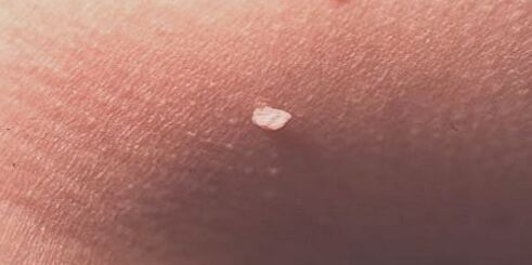 virus del papiloma humano en la piel