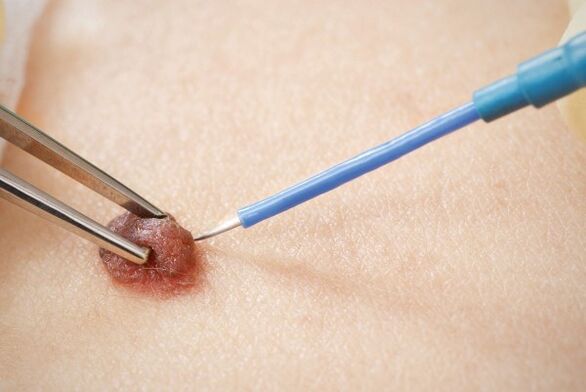 Electrocoagulación del papiloma