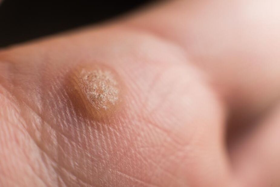 virus del papiloma humano en la piel