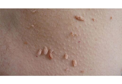 Un signo de infección por VPH es la aparición de papilomas en el cuerpo.
