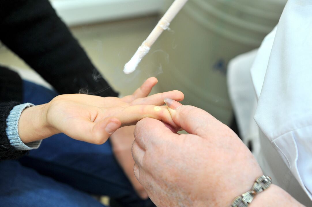 período de recuperación después de la eliminación de las verrugas