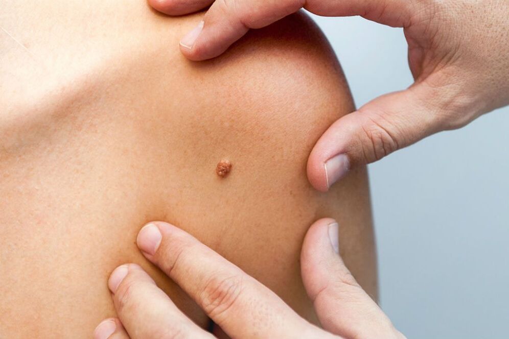 papilomas en el cuerpo humano