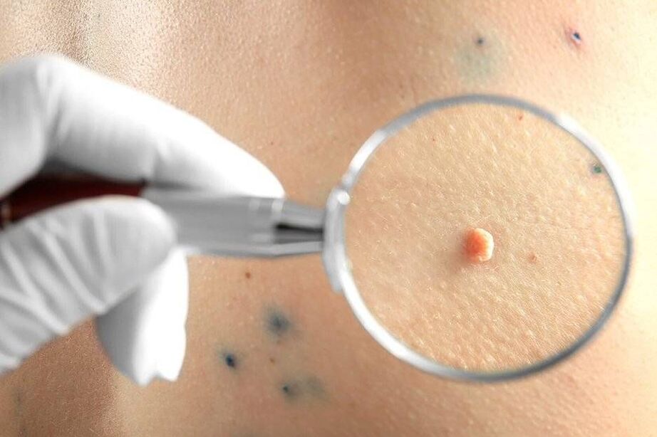 tratamiento del VPH