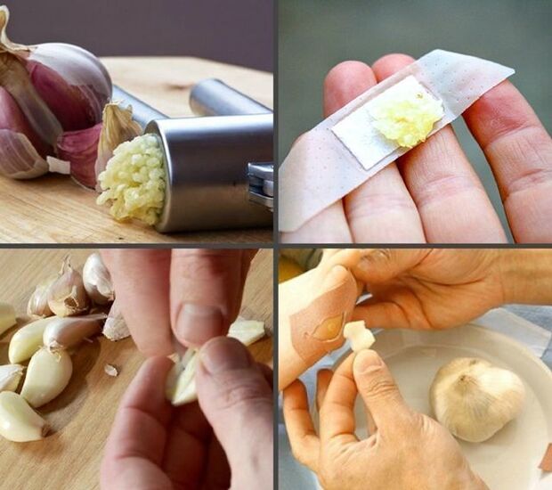 tratamiento de papilomas en las piernas