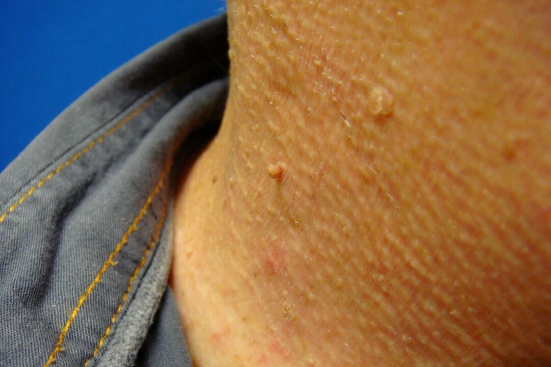papilomas en el cuello humano