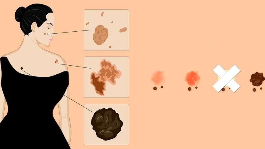 tipos de papilomas en la piel humana