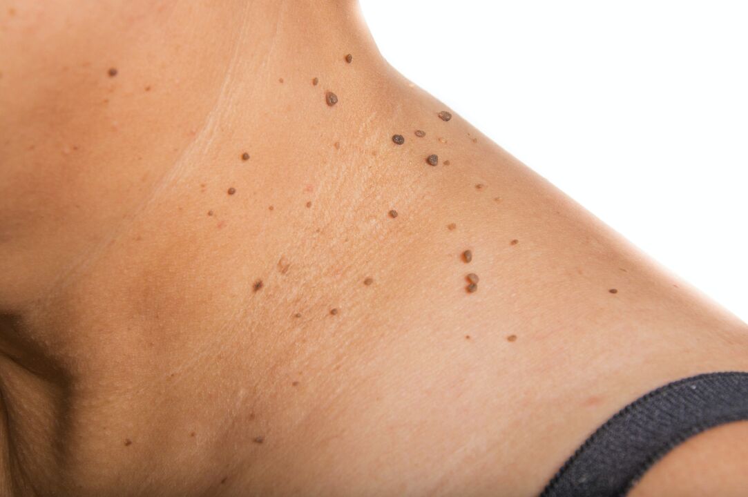 una dispersión de papilomas en el cuello