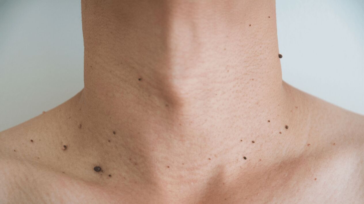 tratamiento con crema Keramin para papilomas en el cuello y el pecho