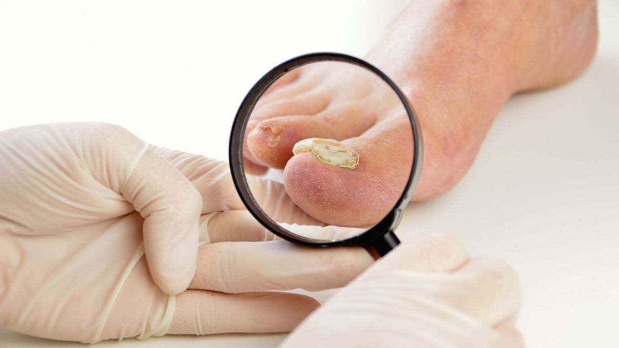 tratamiento de hongos en las uñas con crema Keramin