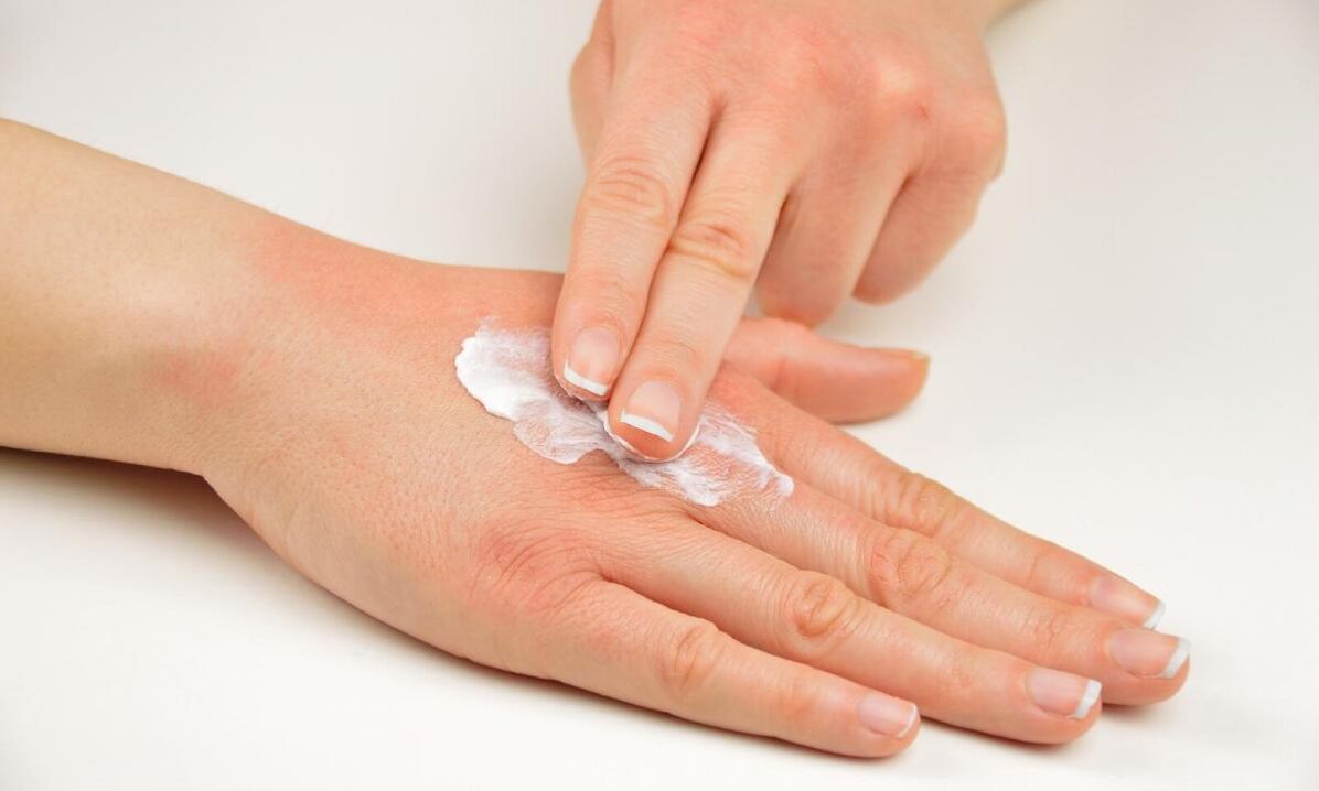 tratamiento de la psoriasis con crema Keramin
